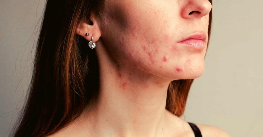What Is Acne and How to Fight It