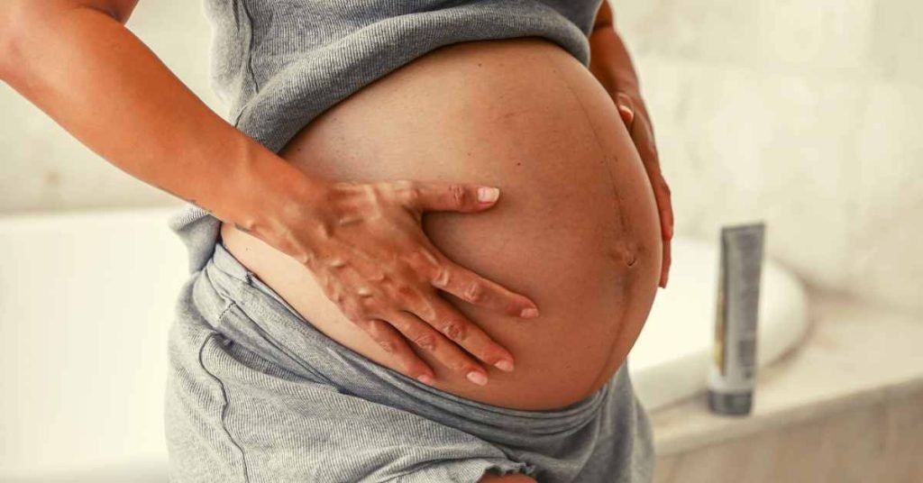Home remedies for stretch marks after pregnancy