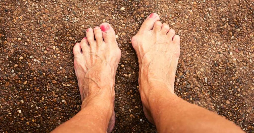 Additional Tips for Bunion Management
