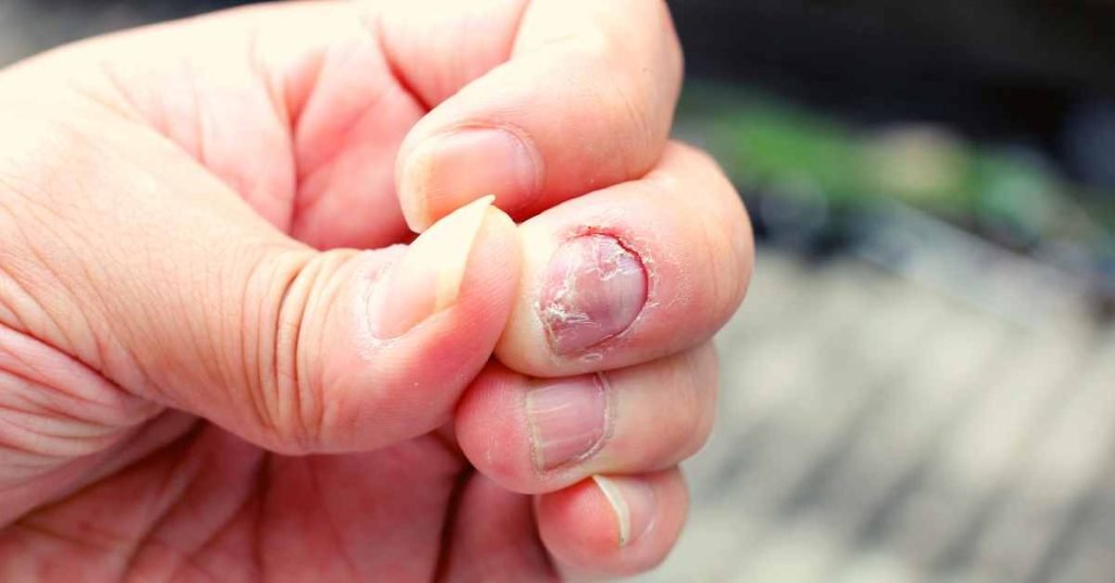 Understanding Fungal Nail Infections