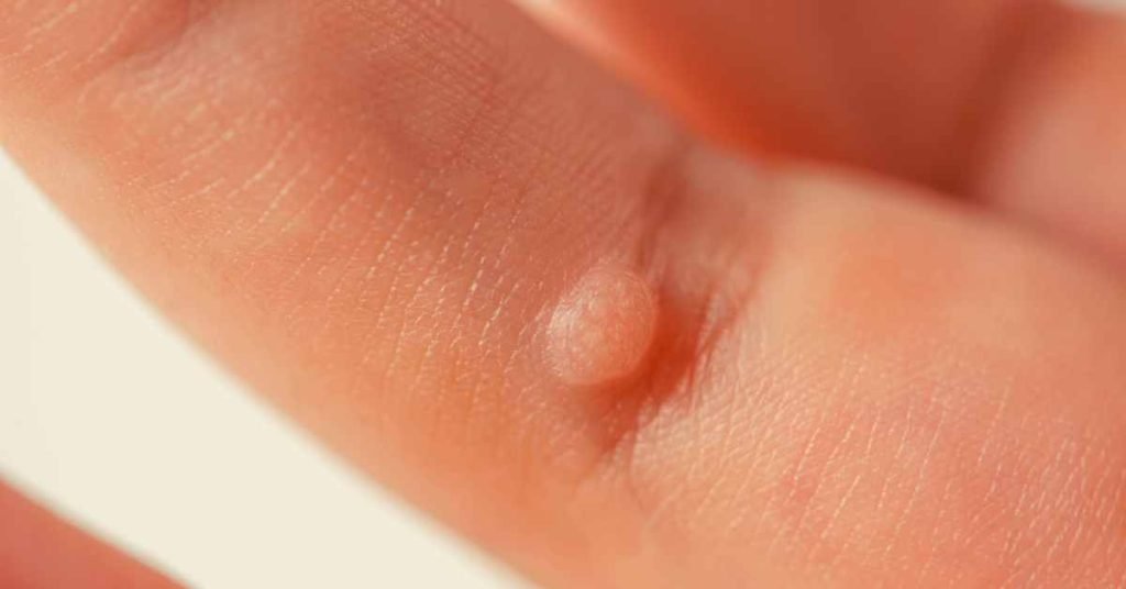 Understanding Genital Warts
