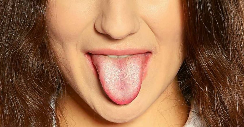 Understanding Oral Thrush