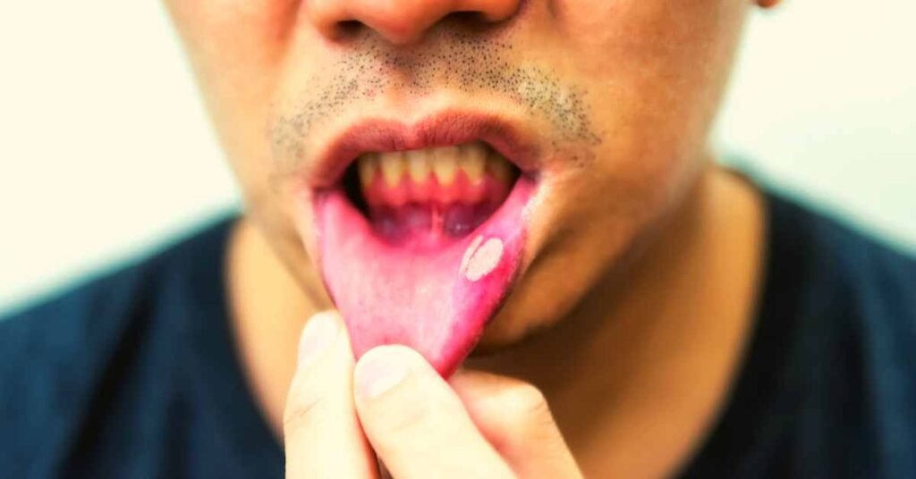 Understanding Mouth Ulcers