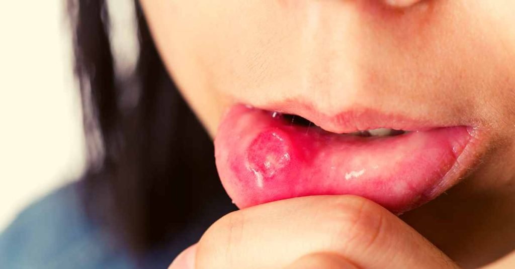 Home remedies for canker sores