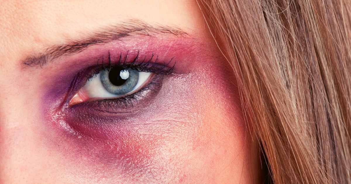 Natural Elixir for Quick Healing: Teas to Treat Black Eyes - It's Never ...