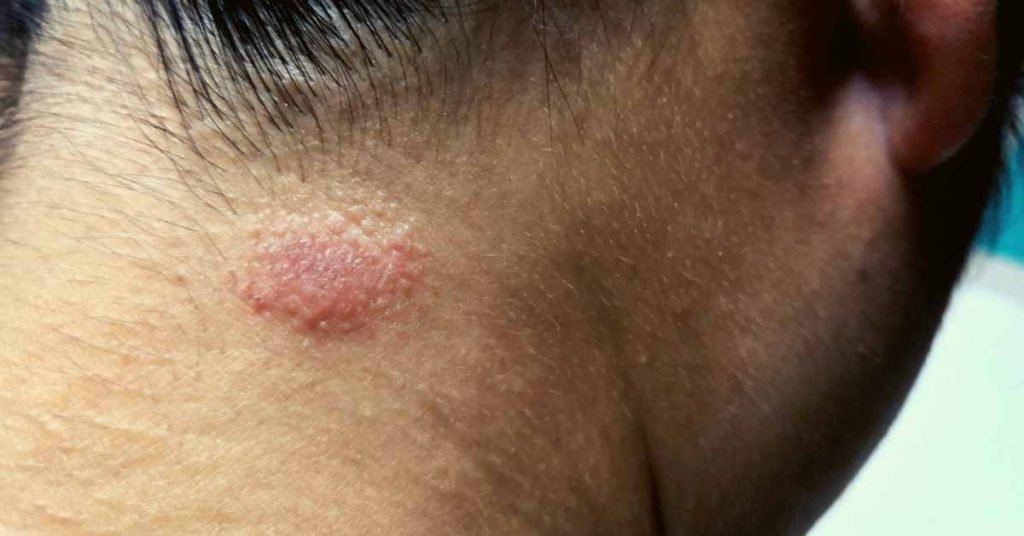 The Therapeutic Efficacy of Tea in Alleviating Ringworm Symptoms