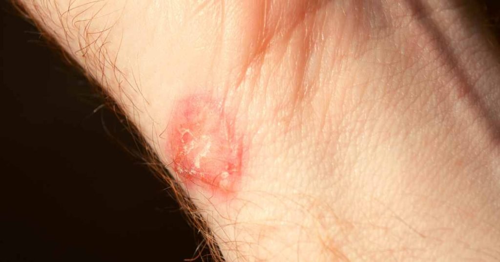 Understanding Ringworm